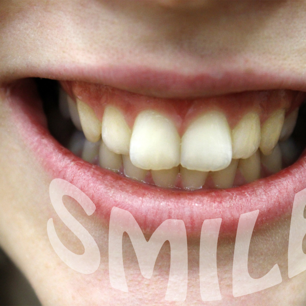 SMILE